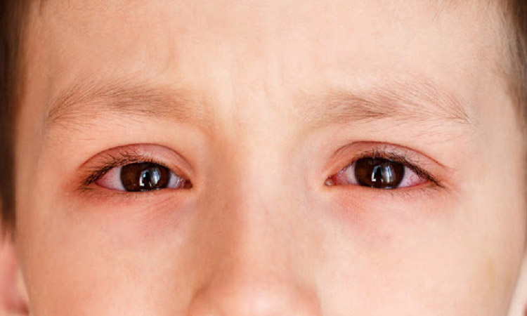 bệnh đau mắt đỏ